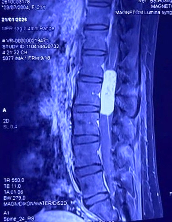 Hạnh phúc nghẹn ngào của người mẹ trẻ sau ca vi phẫu loại bỏ khối u tủy gần 10cm- Ảnh 1. Hạnh phúc nghẹn ngào của người mẹ trẻ sau ca vi phẫu loại bỏ khối u tủy gần 10cm- Ảnh 1.
