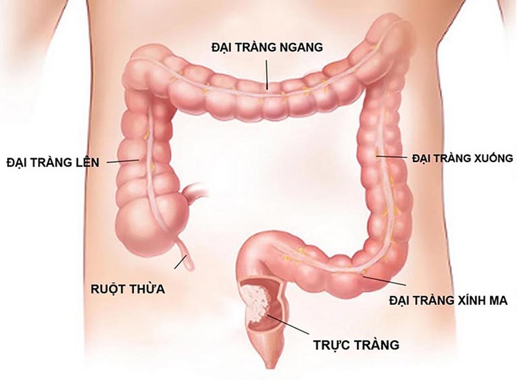 Làm sạch đại tràng là yếu tố quyết định độ chính xác của kết quả nội soi. Ảnh minh họa