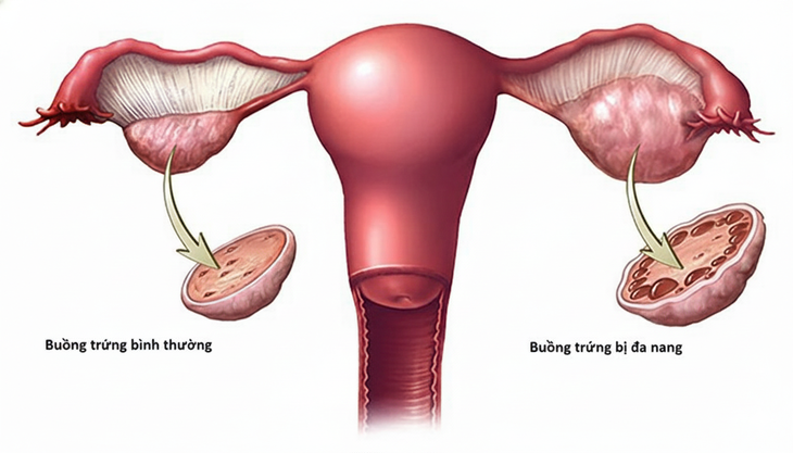 Hội chứng buồng trứng đa nang có gây vô sinh không? Giải đáp từ chuyên gia- Ảnh 1. Hội chứng buồng trứng đa nang có gây vô sinh không? Giải đáp từ chuyên gia- Ảnh 1.