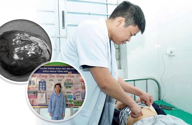 Phẫu thuật cắt lách bán phần điều trị u nang lách khổng lồ- Ảnh 1.
