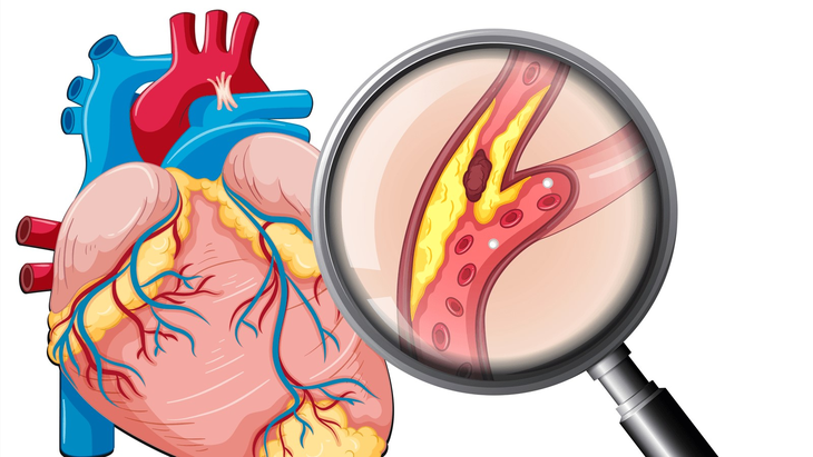 Nguyên nhân tai biến mạch máu não: Những yếu tố âm thầm cần cảnh giác- Ảnh 3.