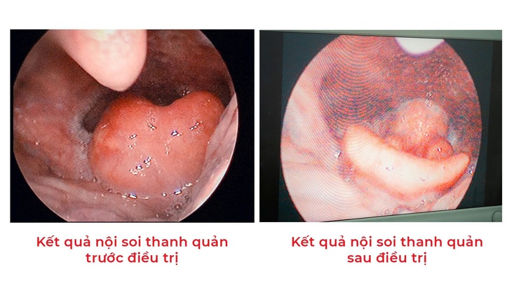 Suýt tắc đường thở vì ngậm vitamin C sủi chữa hóc xương cá- Ảnh 2.