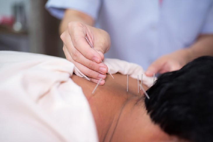 Châm cứu trong y học hiện đại: Giá trị truyền thống, ứng dụng mới - Ảnh 2.