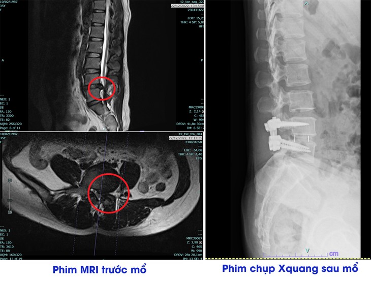 Thoát vị đĩa đệm khi nào cần phẫu thuật?- Ảnh 2.