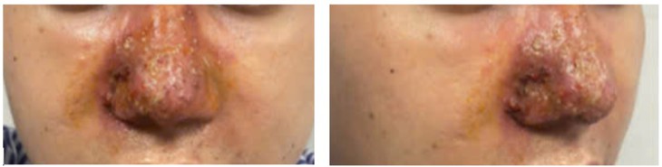 Tiêm filler mũi tại spa, nam bệnh nhân bị hoại tử, chảy mủ chỉ sau 1 ngày - Ảnh 1.