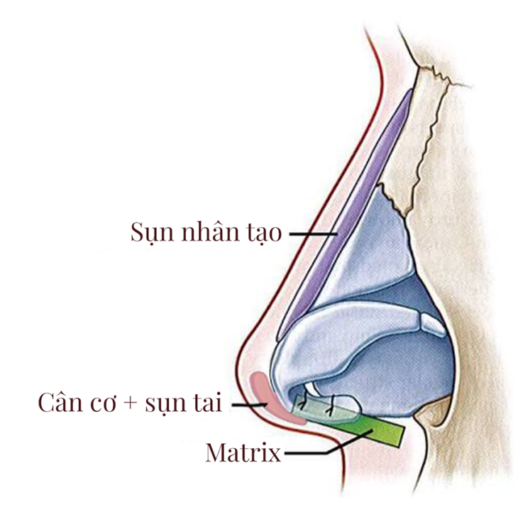 Nâng mũi cấu trúc bảo tồn là gì?- Ảnh 3.