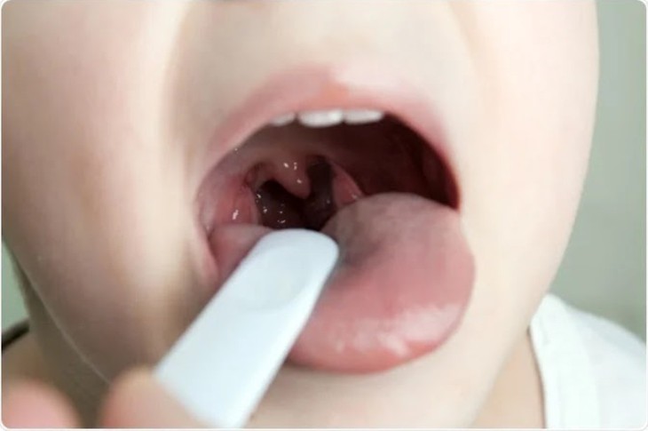 Viêm mũi họng kéo dài ảnh hưởng gì đến sức khỏe trẻ?- Ảnh 1.