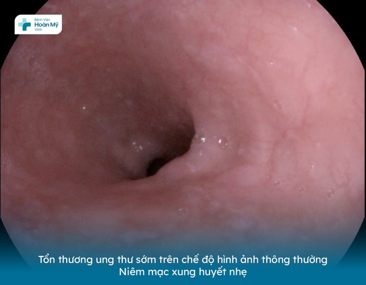 Khám định kỳ tại Hoàn Mỹ Vinh, người nam 53 tuổi phát hiện ung thư sớm - Ảnh 2.