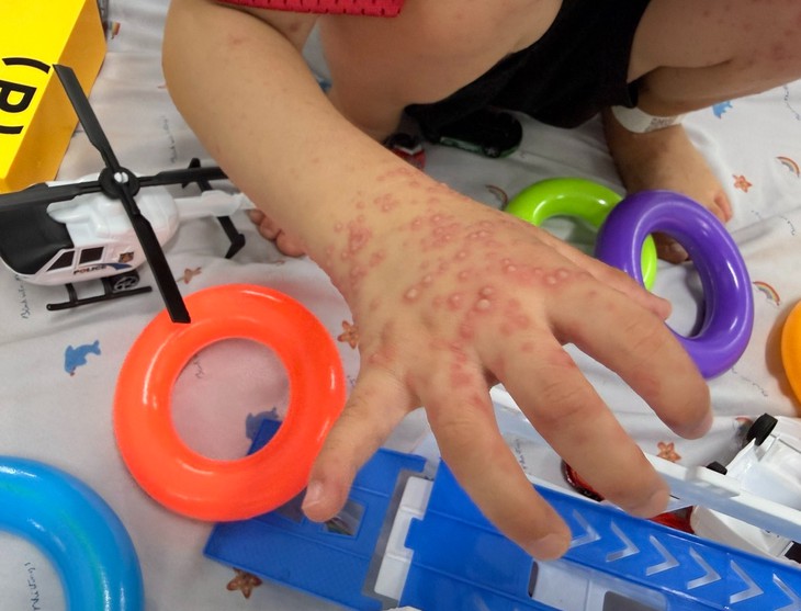 Ca tay chân miệng tăng mạnh, nhiều trẻ đồng nhiễm virus hô hấp - Ảnh 1.