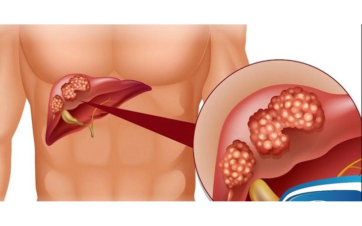 Ngứa ran khắp người nghĩ dị ứng hải sản, hóa ra ung thư gan giai đoạn cuối- Ảnh 4.