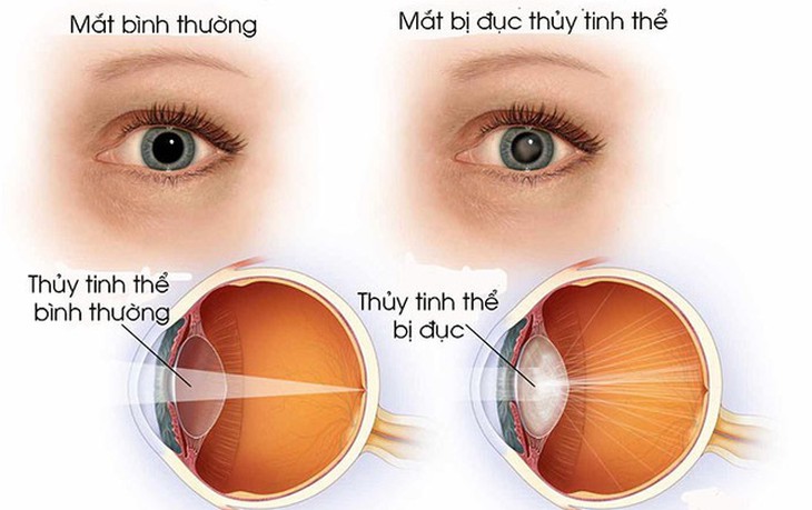 Sai lầm khi chờ đục thủy tinh thể 'chín muồi' mới mổ- Ảnh 3.