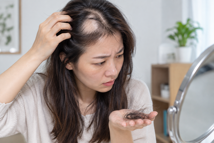 Hướng dẫn chăm sóc da đầu đúng cách khi bị rụng tóc từng mảng - Ảnh 1.