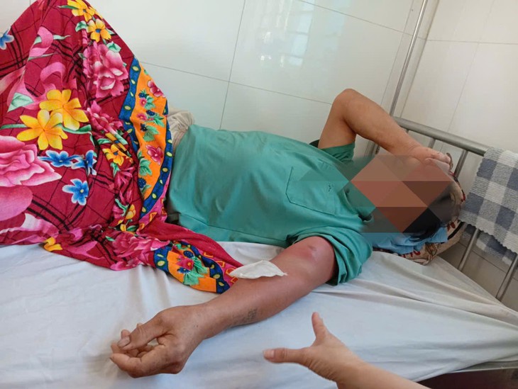 Nhập viện vì giun rồng chui dưới da sau chuỗi ngày đi rừng uống nước suối - Ảnh 1.
