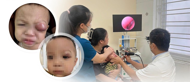 Trẻ 18 tháng tuổi nguy cơ mất thị lực do viêm xoang biến chứng- Ảnh 1.