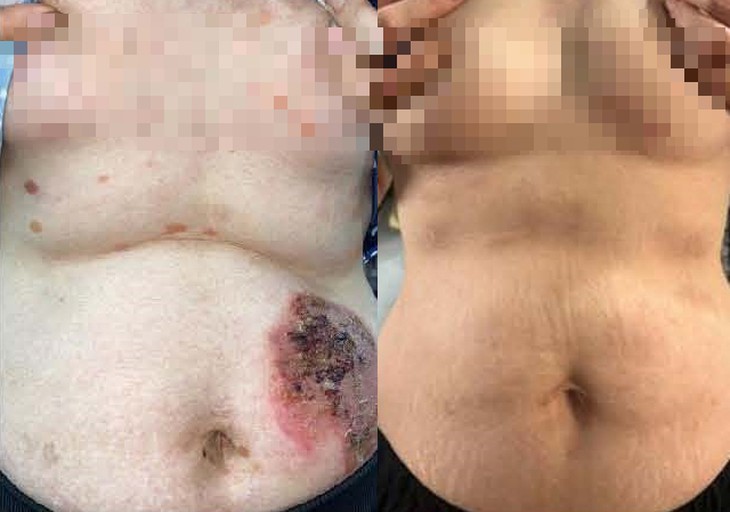 Lành vết trợt niêm mạc miệng, hết đau rát sau 7 năm vật lộn với bệnh Pemphigus - Ảnh 1.