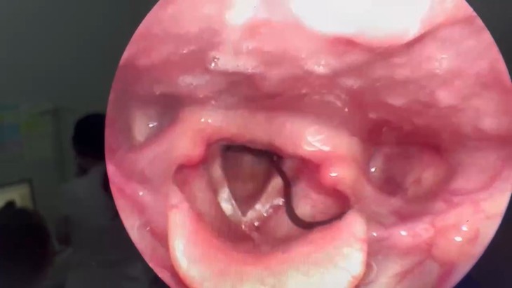 Bắt đỉa sống trong thanh quản người phụ nữ có thói quen uống nước ở suối- Ảnh 1.