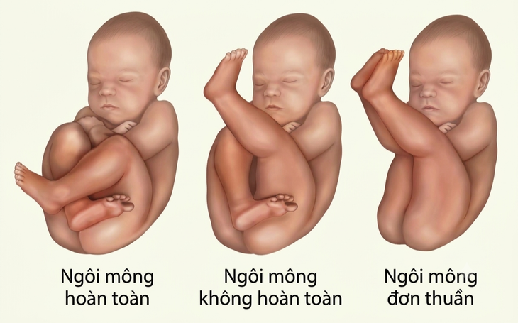 Thai nhi ngôi ngược: Nguyên nhân, xử trí và lựa chọn sinh nở an toàn - Ảnh 1.
