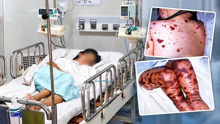 Cách nhận biết bệnh não mô cầu với cúm, sốt xuất huyết và các bệnh phát ban- Ảnh 2.