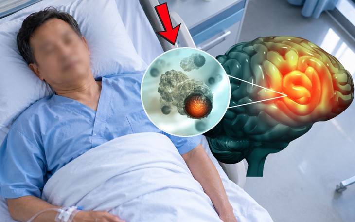 Chuyên gia cảnh báo những nguy cơ âm thầm dẫn đến ung thư gan- Ảnh 4.