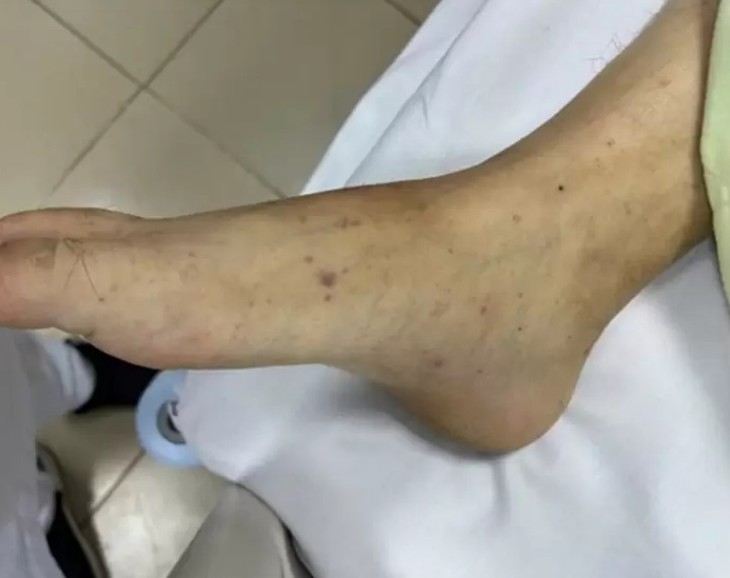 Bệnh do não mô cầu có tỷ lệ mắc thấp, tại sao vẫn xảy ra bùng phát?- Ảnh 2.