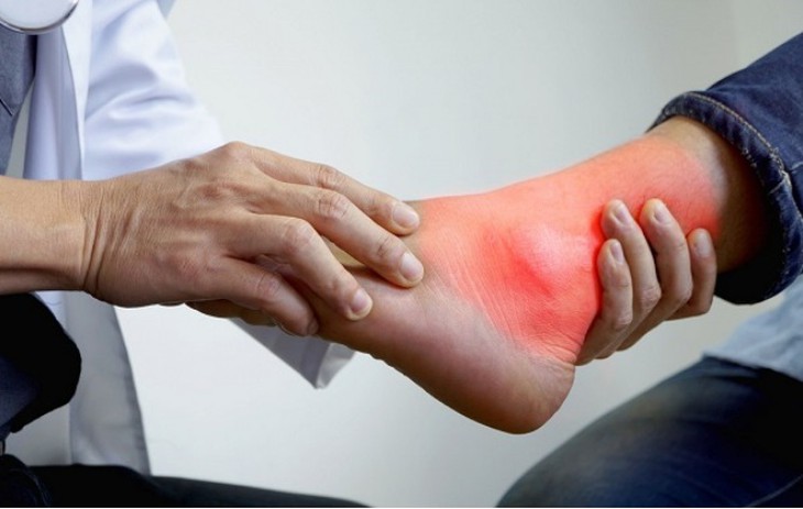 Bệnh gout không chỉ do ăn uống- Ảnh 2.