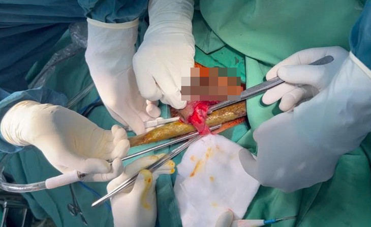 Hai thanh sắt đâm xuyên bụng, bác sĩ 4 chuyên khoa phối hợp cứu chữa - Ảnh 1.