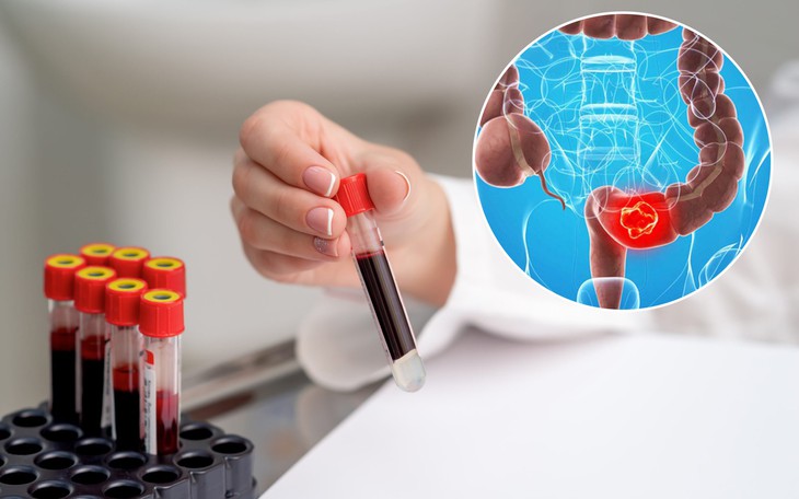 Sau 60 tuổi mắc ung thư đại trực tràng cần làm gì?  - Ảnh 3.
