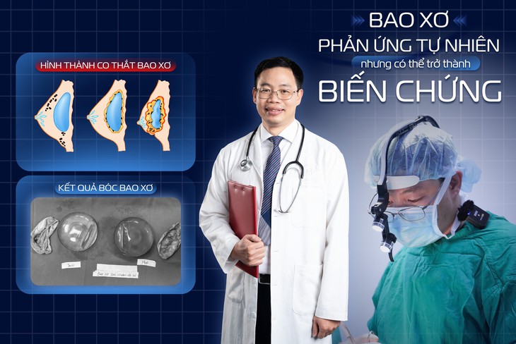 Bao xơ sau nâng ngực: Vì sao cần quan tâm đến kỹ thuật phẫu thuật?- Ảnh 1.