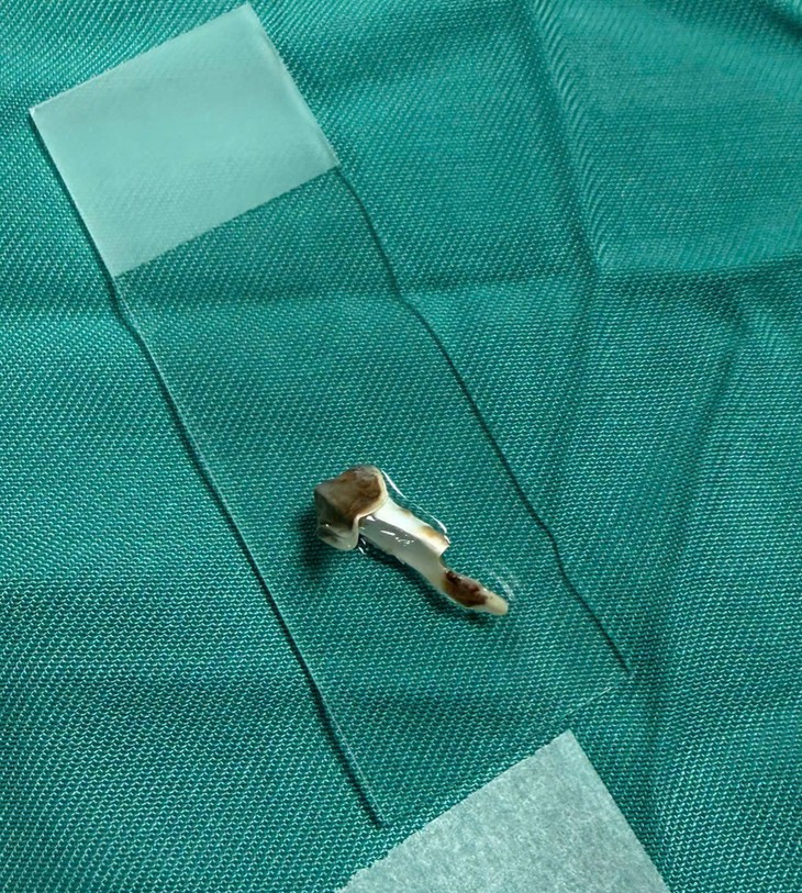 Bé trai 13 tuổi ho kéo dài hơn 3 năm, bác sĩ phát hiện dị vật nhựa trong phế quản- Ảnh 2.