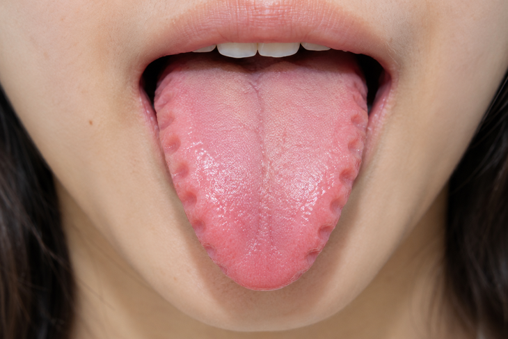 Lưỡi hằn dấu răng cảnh báo điều gì? - Ảnh 1.