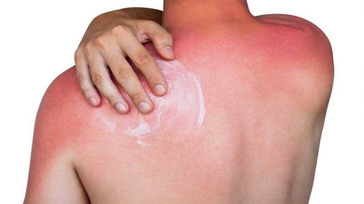 Trào lưu phơi nắng 'trị bách bệnh' có nguy cơ ung thư da- Ảnh 1.