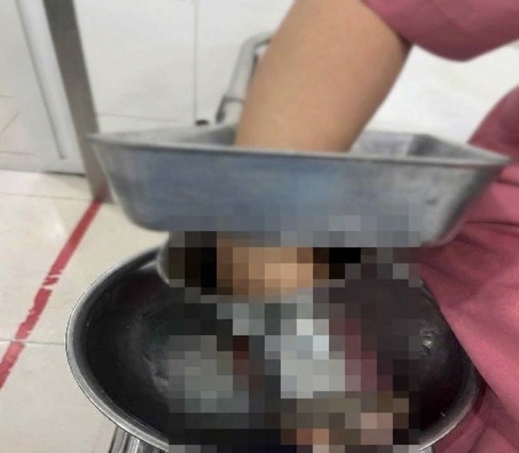 Nữ nhân viên nấu ăn ở trường học bị bàn tay phải cuốn vào máy xay thịt - Ảnh 1.