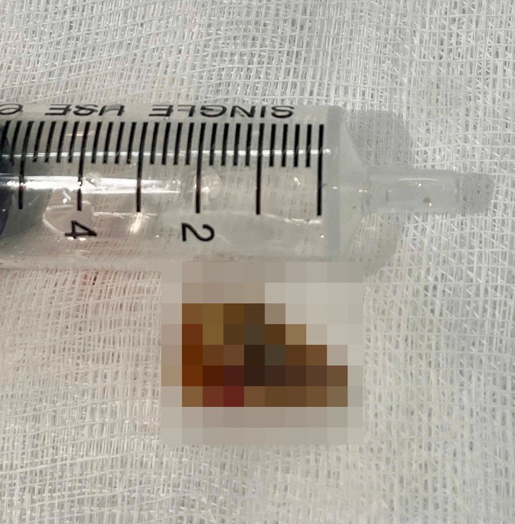 Mảnh xương 2 cm nằm sâu trong phế quản, gây tắc phổi và nhiều ổ mủ
- Ảnh 1.