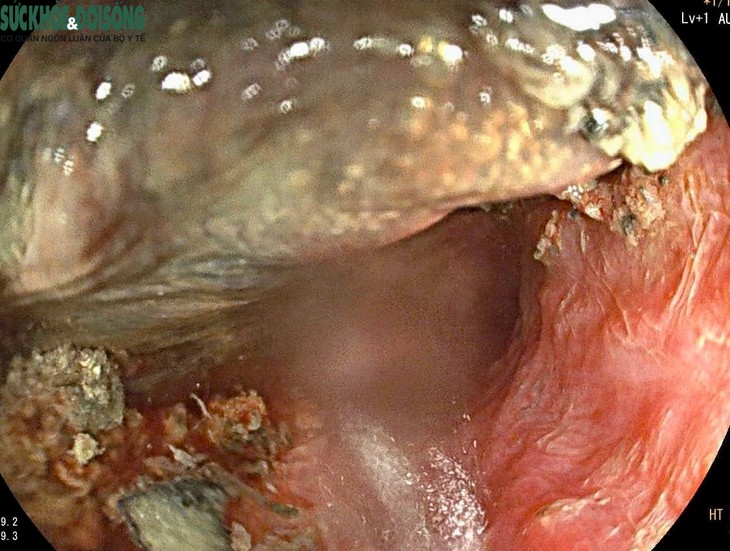 Trẻ bị tổn thương nghiêm trọng thực quản vì pin cúc áo, bác sĩ khuyến cáo- Ảnh 1.