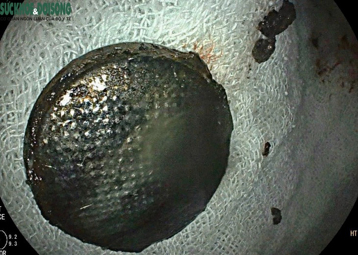 Trẻ bị tổn thương nghiêm trọng thực quản vì pin cúc áo, bác sĩ khuyến cáo- Ảnh 2.
