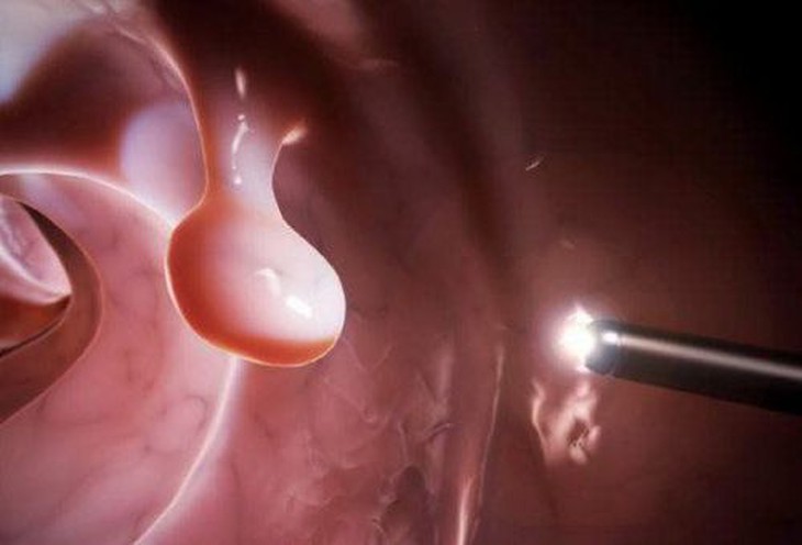 Đa polyp túi mật có nguy hiểm không? - Ảnh 1.