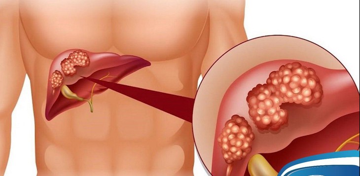 Gan nhiễm mỡ khi nào phải dùng thuốc kết hợp với ăn kiêng? - Ảnh 2.
