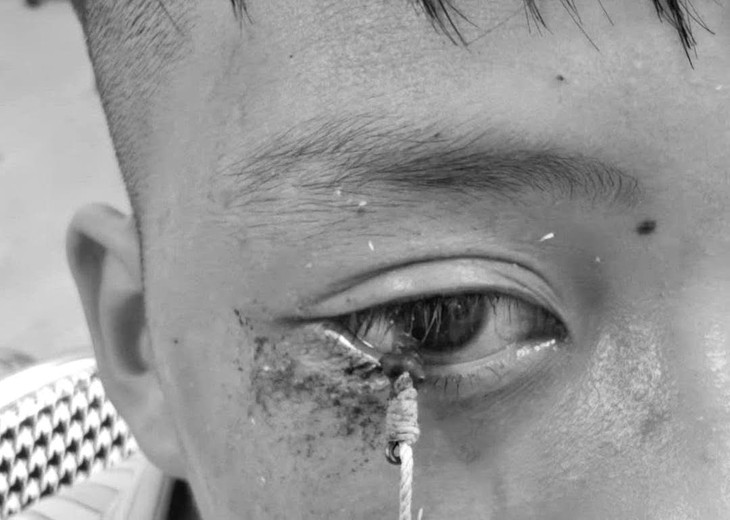 Cấp cứu bệnh nhân bị lưỡi câu móc vào rìa giác mạc- Ảnh 1.
