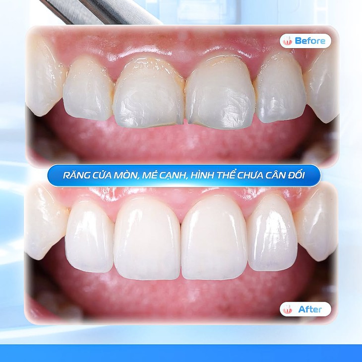 Bọc sứ Veneer không mài: Khi nụ cười đẹp đi cùng hàm răng khỏe- Ảnh 3.