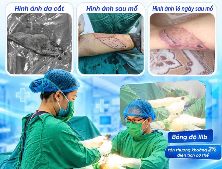 Thanh niên được phẫu thuật ghép da sau bỏng bô xe máy - Ảnh 1.