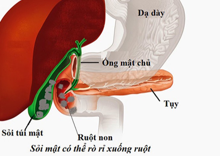 Sỏi túi mật khi nào cần mổ cấp cứu?- Ảnh 2.