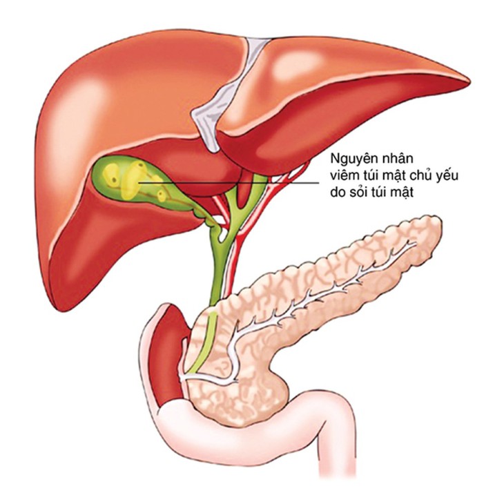Sỏi túi mật khi nào cần mổ cấp cứu?- Ảnh 1.