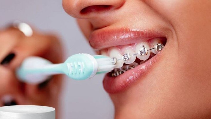Vệ sinh răng miệng khi niềng răng như thế nào? - Ảnh 1.