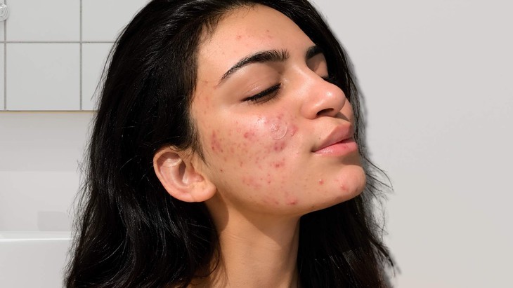 Serum cho da dầu mụn giúp sáng mịn, mờ thâm- Ảnh 1.