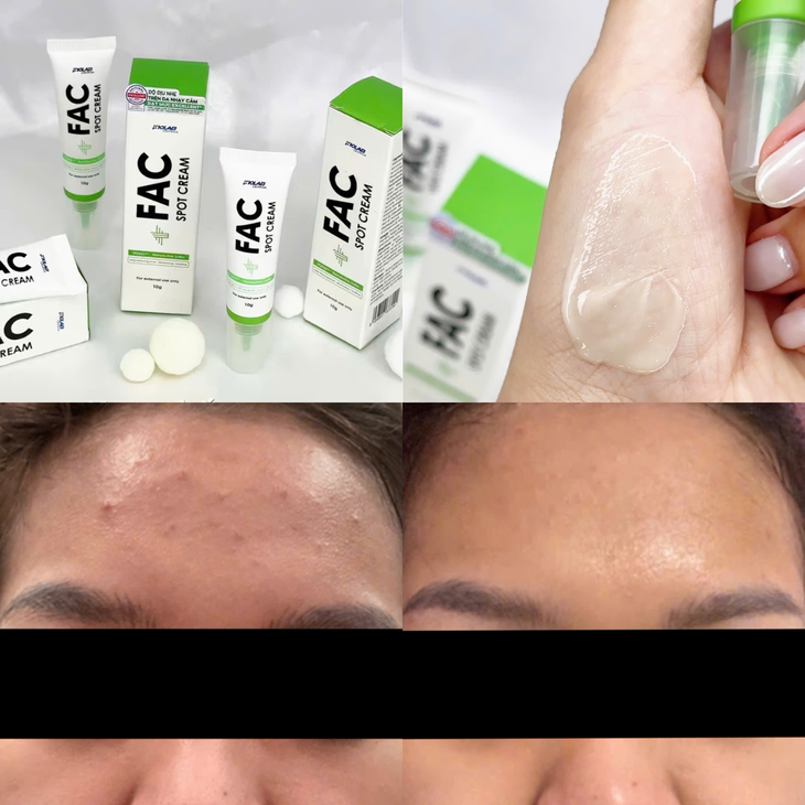 Inolab Derma FAC Spot Cream giải pháp chăm sóc da mụn không chứa AHA, BHA - Ảnh 4.