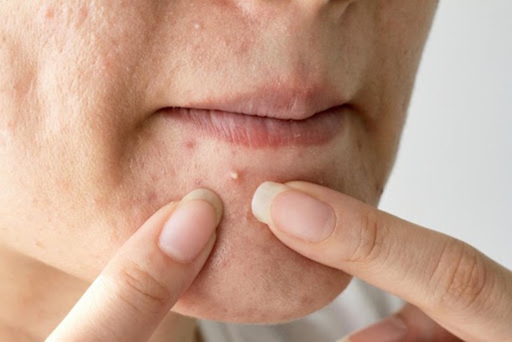 5 cách giảm nguy cơ để lại vết thâm sau mụn trứng cá- Ảnh 1.