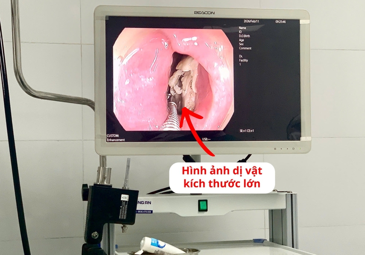 Lấy xương gà kích thước lớn mắc kẹt trong thực quản bệnh nhân- Ảnh 1.