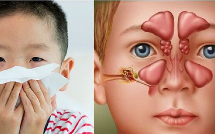 Áp xe hốc mắt ở trẻ: Cảnh giác biến chứng do viêm xoang- Ảnh 1.
