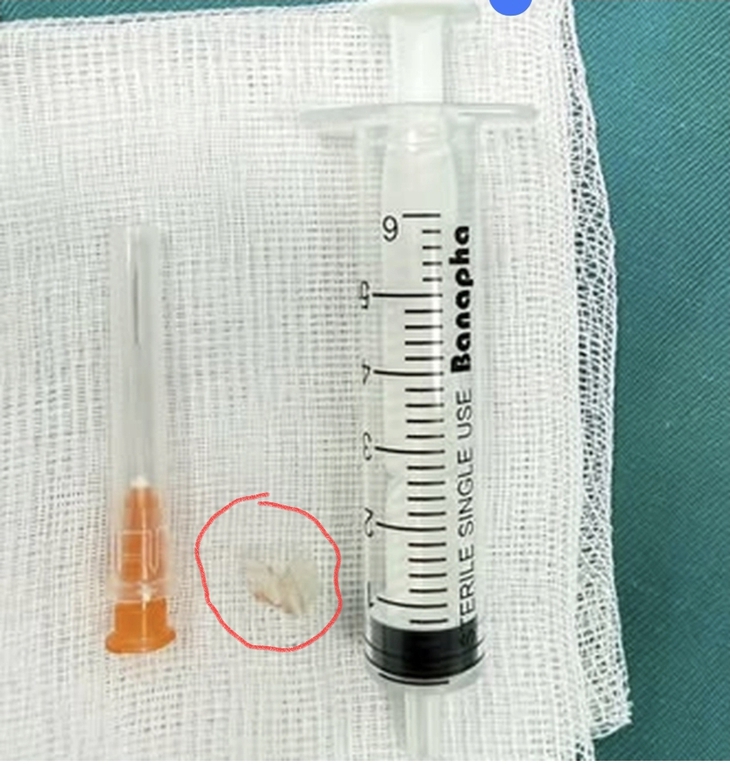 Mảnh nhựa sắc nhọn được các bác sĩ nội soi gắp ra khỏi đường thở bệnh nhi.