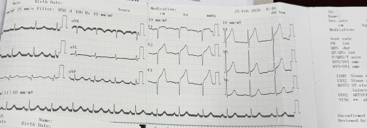 Nhồi máu cơ tim và cuộc đua từng phút trong phòng cấp cứu- Ảnh 1.